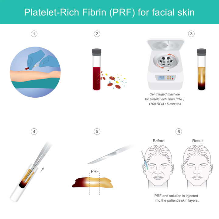 PRF - Ten Amazing Facts You Will Love to Know About PRF - Ageless Aesthetics