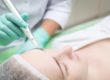 Microneedling After sculptra