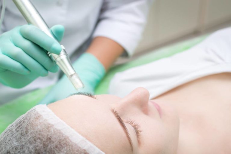 Microneedling After sculptra