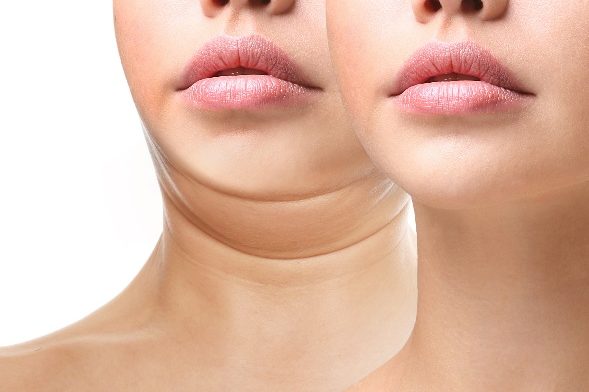 Is Kybella Safe and Does it Really Work | Ageless Aesthetics