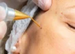 Plasma Pen Fibroblast Treatment in Ageless Aesthetics