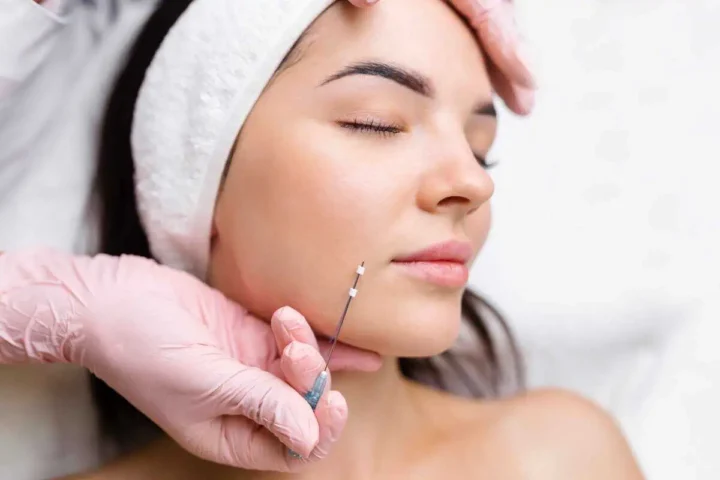 PDO Thread Lift in Moscow, id at Ageless Aesthetics