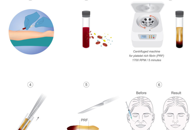 PRF - Ten Amazing Facts You Will Love to Know About PRF - Ageless Aesthetics